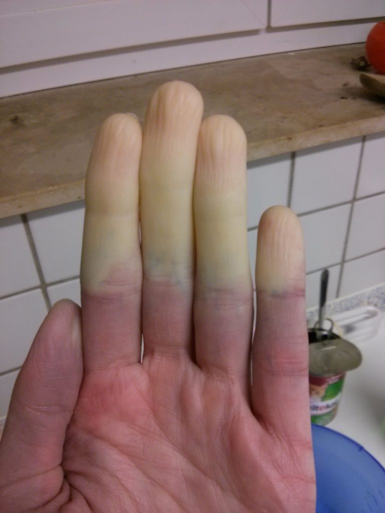 Meine allabendliche Zombiehand, direkt von heute. Finger sind noch dran!