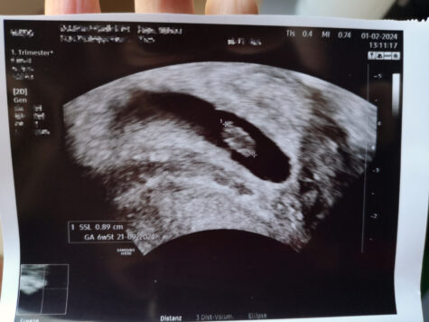 Ultraschallbild des Fötus in der 7. Schwangerschaftswoche. Er war 0,89 cm groß.